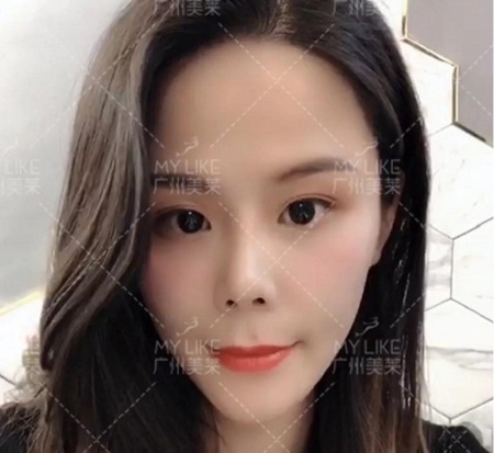 速美打造神奇——玻尿酸,讓你蛻變!