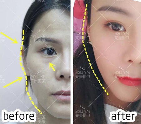 玻尿酸,讓你蛻變!