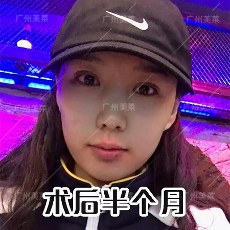 下垂眼割無辜桃花眼后，美成咋樣了？