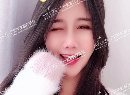 3個小姐姐真實(shí)分享,肋軟骨隆鼻感受!