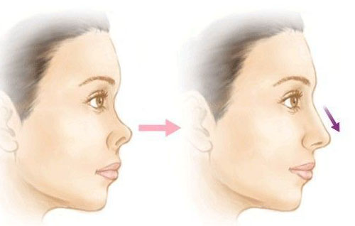 注射玻尿酸隆鼻能維持多少個(gè)月？