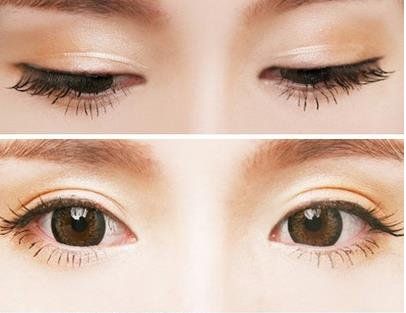 埋線雙眼皮能維持多久?