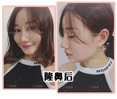 塌鼻進(jìn)化史:“日拋鼻”我不爽你很久了!