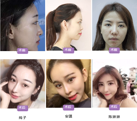 看完這些,你能避開所有隆鼻誤區!