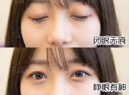 陰森小眼<a href='/ybzx/syp/' target='_blank'><u>割雙眼皮</u></a>后7天,竟如小鹿般精靈可愛(ài)?