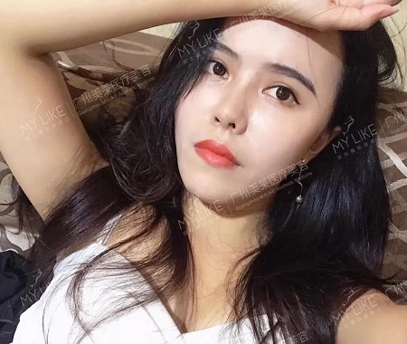 隆鼻后逆襲成女神?