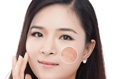 祛黃褐斑的價格大概是多少?