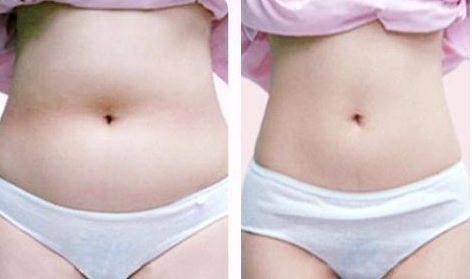 抽脂手術一般多少錢？