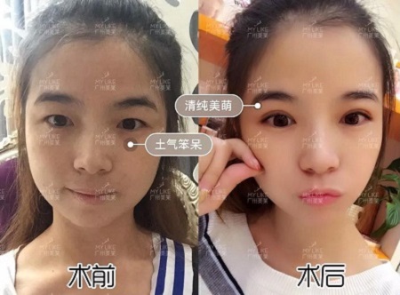 割完雙眼皮氣質(zhì)大變身?。?！