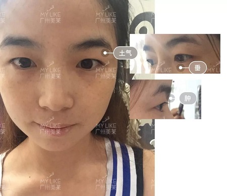 割完雙眼皮氣質(zhì)大變身！??！