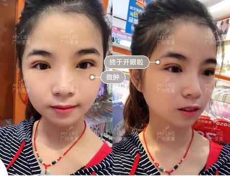 割完雙眼皮氣質(zhì)大變身！??！