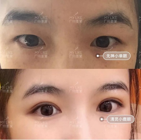 割完雙眼皮氣質(zhì)大變身?。?！