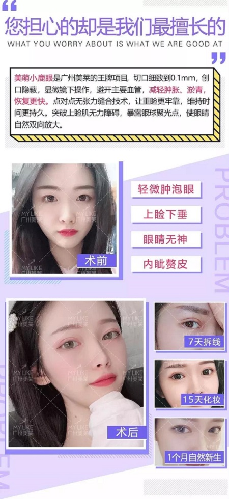 割完雙眼皮氣質(zhì)大變身?。?！