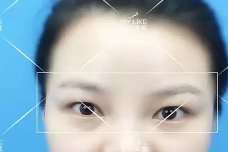 腫眼泡不僅難看還更容易衰老!