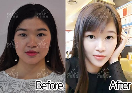 玻尿酸瘦臉針通通￥399！吃土女孩必buy！