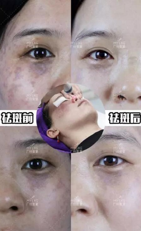 4.14祛斑學術盛會即將啟幕,敬請關注!