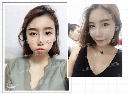 自體脂肪填充后, 從阿姨臉秒變*齡少女臉!