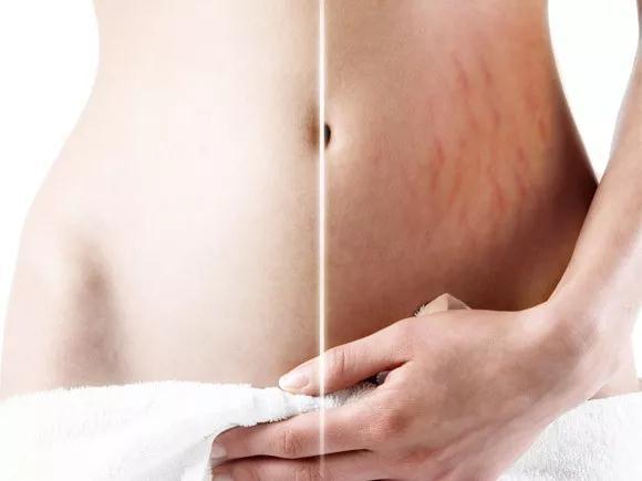 射頻去妊娠紋手術價格是多少？