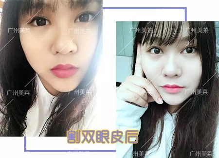 懵豬小眼割雙眼皮后，睜眼美到跪！