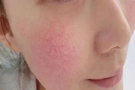 經常“紅臉蛋”是病,得治!