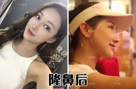 隆鼻3天后，從素人撞臉關曉彤？