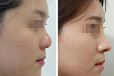 肋軟骨隆鼻多久恢復好?