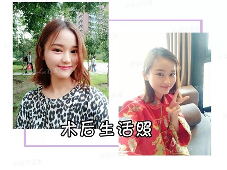 我近視做雙眼皮，對(duì)眼睛有影響嗎？圍觀小姐姐術(shù)后反饋！