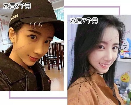 鼻修復7個月后,朝天鼻蛻變驚艷,側顏美炸天!