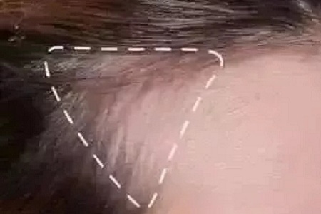 發際線種植,術后40天,成活率感人!