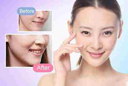 全臉脂肪填充要注意什么?