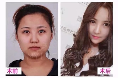 鼻子有這2個bug，影響顏值又顯老！