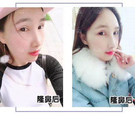 隆鼻7天后，塌鼻妹紙變焦點(diǎn)女神？