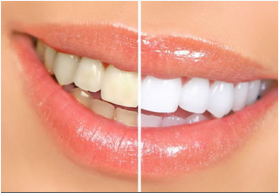 冷光美白牙齒多少錢？