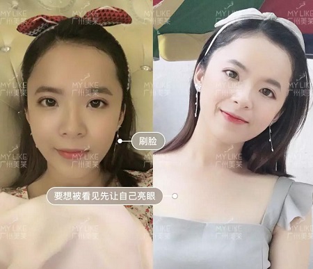 22歲畢業禮,竟被爸媽拉去割雙眼皮?!