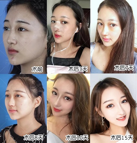 隆鼻后7天拆線，10天上妝美炸天！