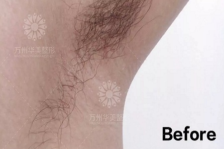 萬人脫毛節丨脫毛到底要幾次才能脫干凈呢?