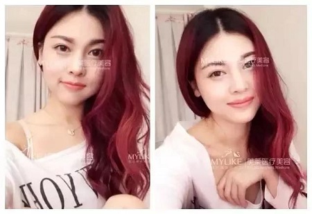 為什么打了玻尿酸，還要我再打玻尿酸？