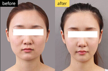 瘦臉多少錢一針?