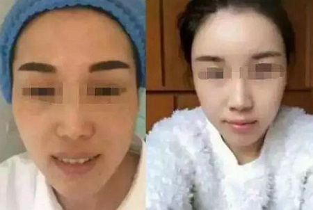 自體脂肪活顏精*,讓你年輕20歲