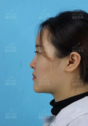 “鼻綜合”后假又歪,還攣縮?鼻修復(fù)還原自然生態(tài)美鼻