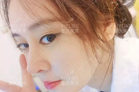 “鼻綜合”后假又歪,還攣縮?鼻修復(fù)還原自然生態(tài)美鼻