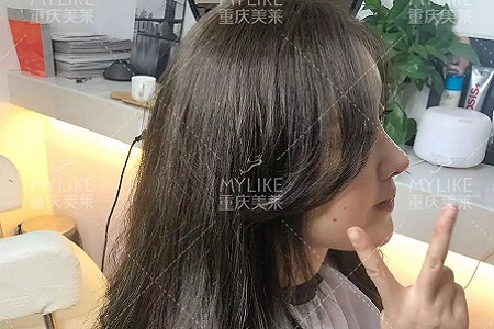 “鼻綜合”后假又歪,還攣縮?鼻修復(fù)還原自然生態(tài)美鼻