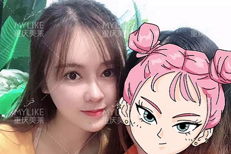 “鼻綜合”后假又歪,還攣縮?鼻修復(fù)還原自然生態(tài)美鼻