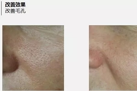 抗衰老的“水光”究竟為何飽受稱贊?