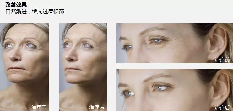 抗衰老的“水光”究竟為何飽受稱贊?