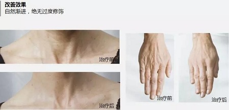 抗衰老的“水光”究竟為何飽受稱贊?