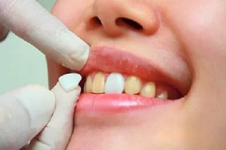 給牙齒“改頭換面”， 讓牙齒看起來(lái)又白又美~