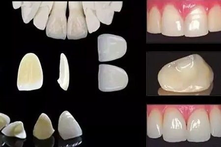 給牙齒“改頭換面”， 讓牙齒看起來(lái)又白又美~