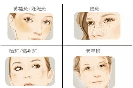 祛斑偏方“害死人”，小仙女們可長點心吧！