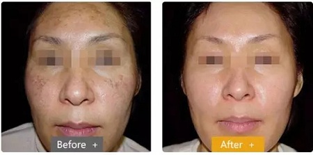 祛斑偏方“害死人”，小仙女們可長點心吧！